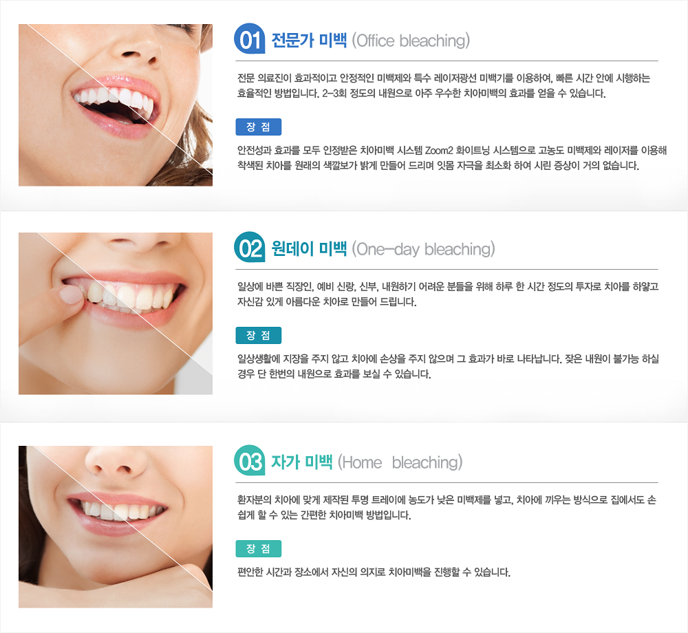 치아미백 치료종류